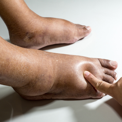 Swollen diabetic foot with visible edema
